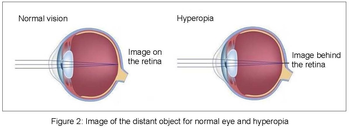 presbyopia hyperopia asigmatizmus rövidlátás