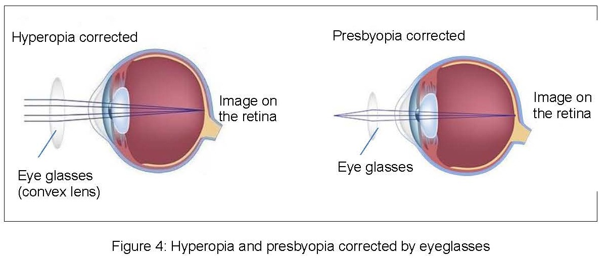 presbyopia hyperopia)