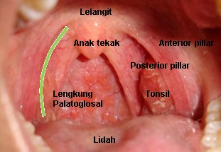 Tonsil bengkak