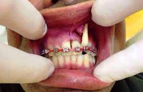 Image Result For Fake Braces Malaysia