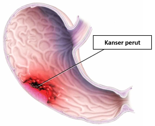 Kanser Perut Portal Myhealth