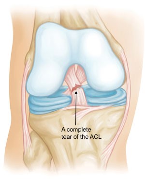 ACL1