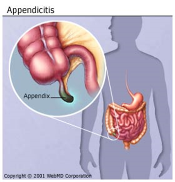 Punca appendix pecah