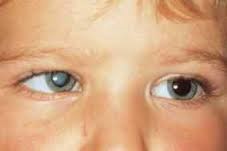 Eye disease - Cataract