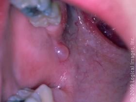 Minor salivary gland pathology