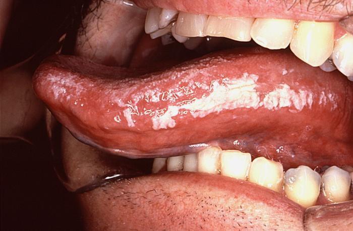 Oral Hairy leukoplakia