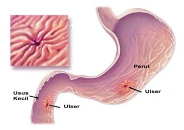 Pembentukan rekahan pada usus dan perut akibat jangkitan H.pylori