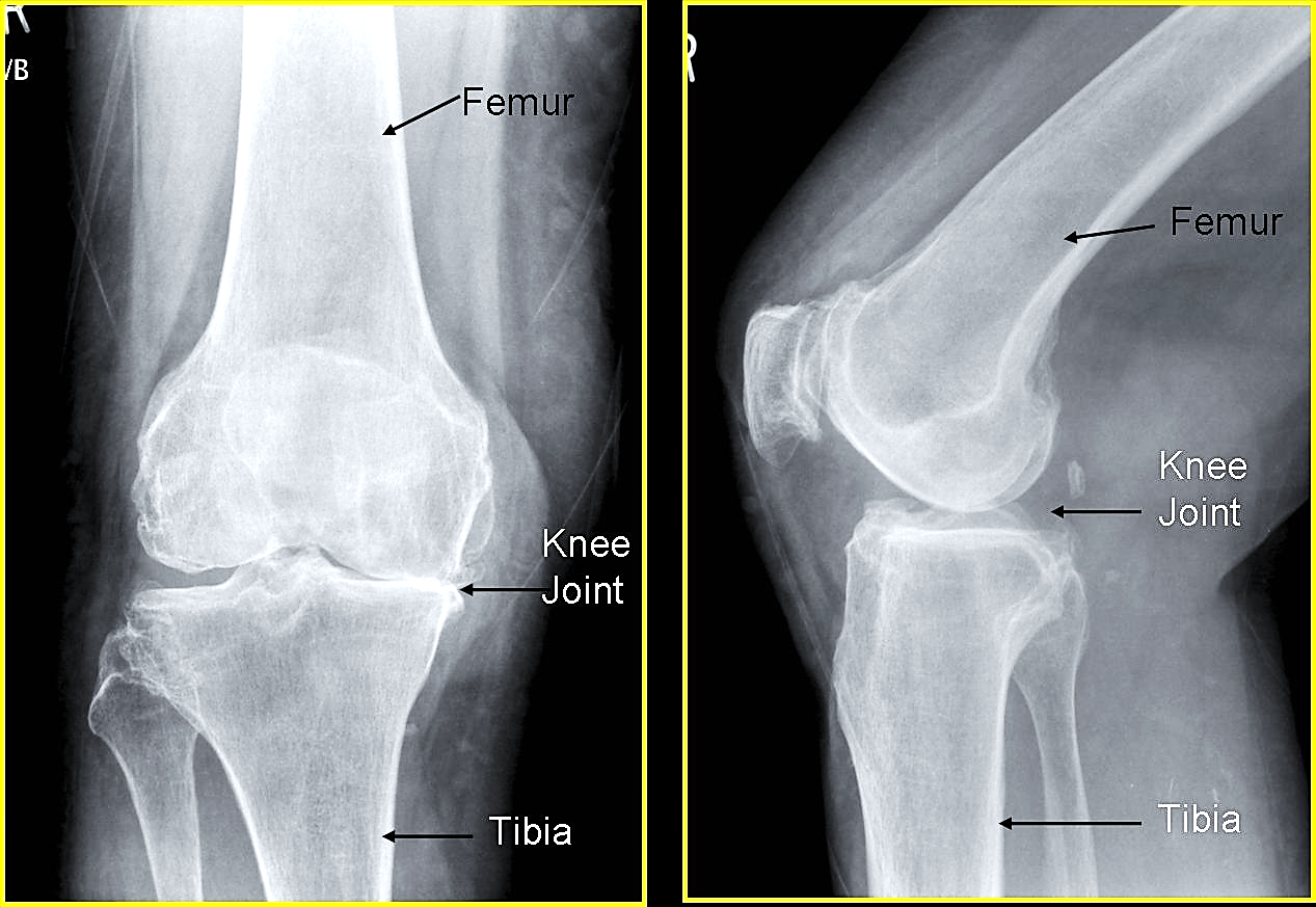 pemeriksaan_x-ray_lutut_2