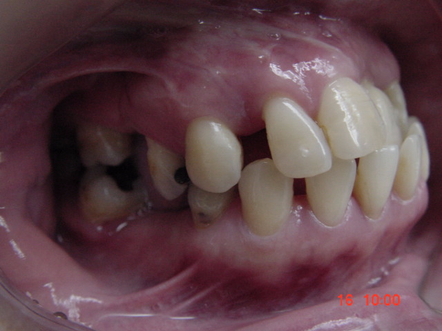 Penyusunan gigi dengan braces untuk memudahkan penggantian gigi1