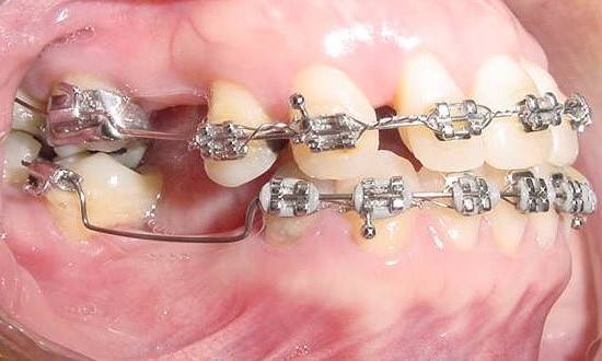 Penyusunan gigi dengan braces untuk memudahkan penggantian gigi2