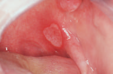 Recurrent aphthous ulcer