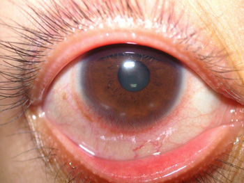 The cornea has five layers