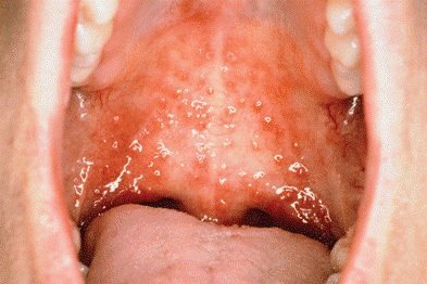 Vesicular Lesions Of HSV Infection On Palate