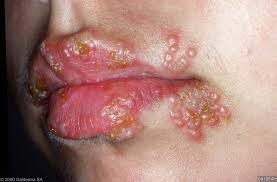 Vesicular Lesions Of Hsv Infection On Lip