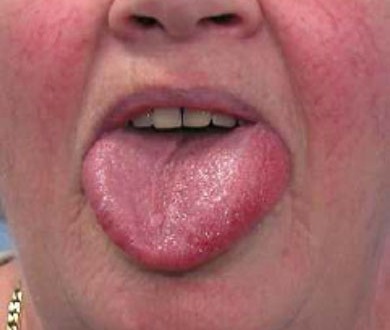 Allergy ibuprofen penicillin Drug Allergy: