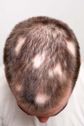 Alopecia pronunciation