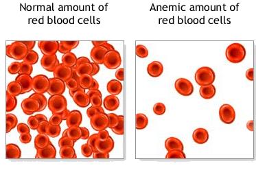anemia1