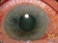 Description: C:UsersuserDesktopangleclosure-glaucoma.jpg