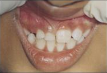 causes of delayed permanent teeth eruption