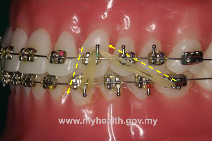 The effects of wearing Elastics (Rubber Bands) during braces..