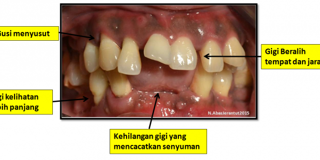 Maksud penyakit periodontium