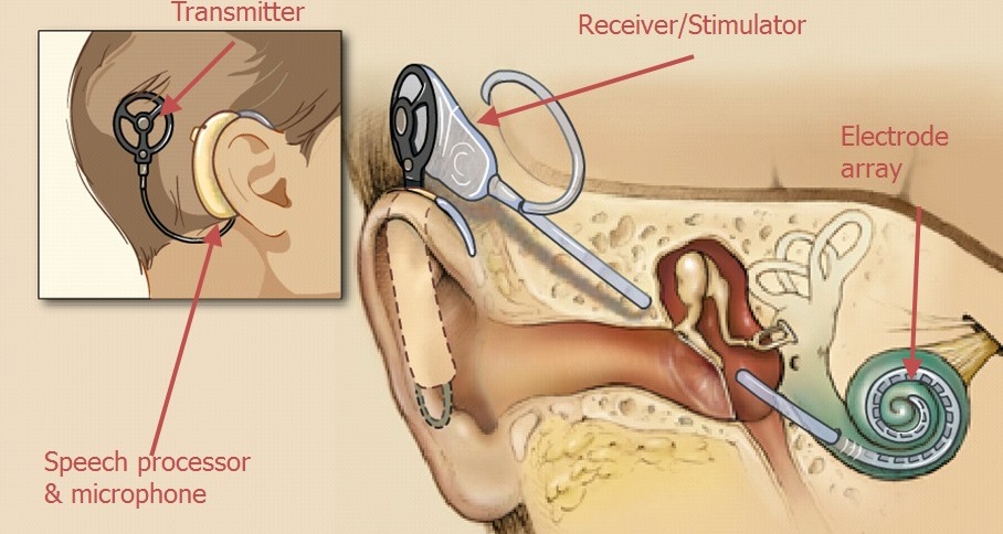 implantable_hearing_aid1