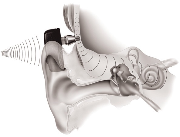 implantable_hearing_aid3