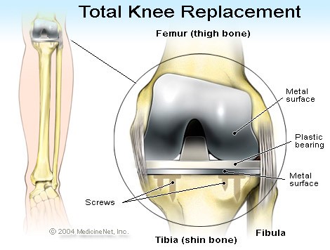 knee-replacement2
