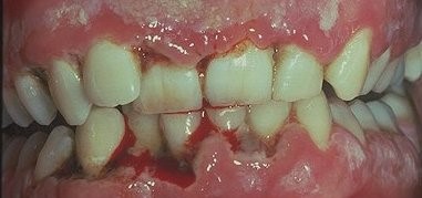 necrotizing-ulcerative-periodontitis