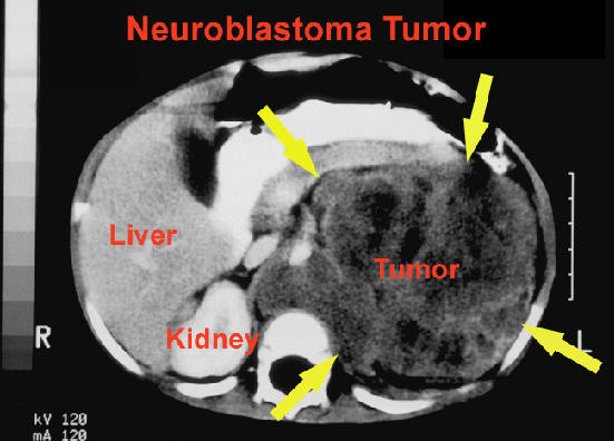 neuroblastoma1