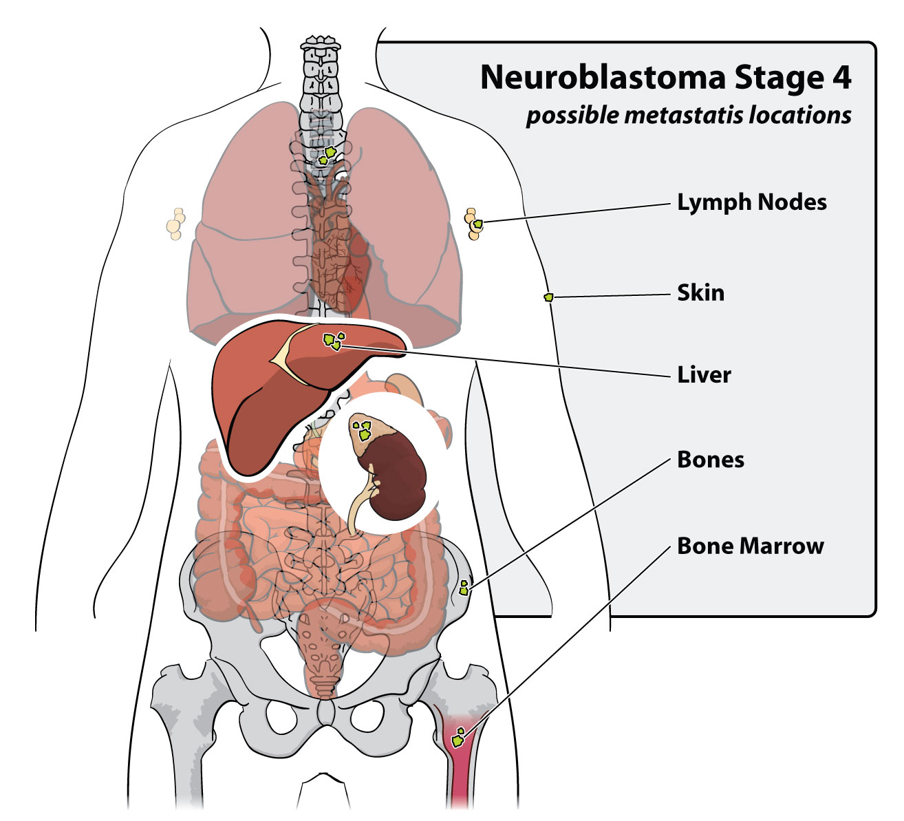 neuroblastoma6