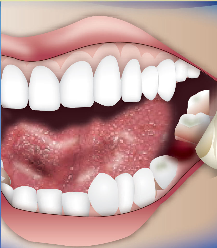 dry socket in upper teeth