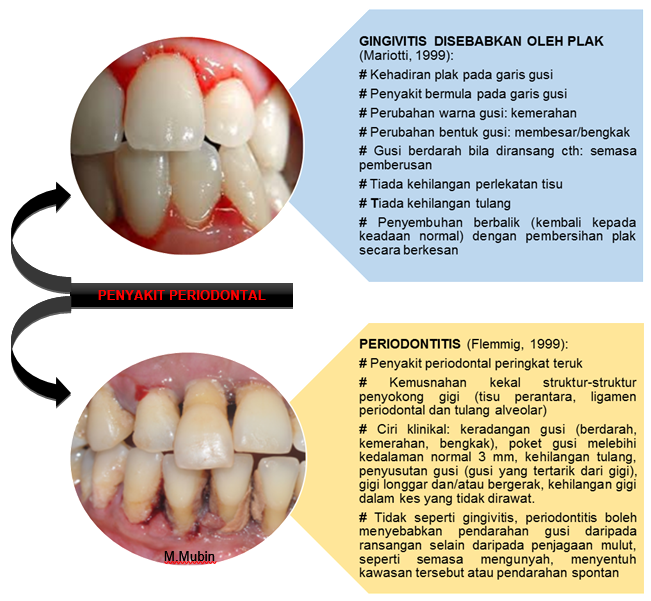penyakit periodontal