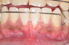 Apakah yang dimaksudkan dengan penyakit periodontium