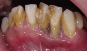 Dengan periodontium apakah yang dimaksudkan penyakit Penyakit Autoimun