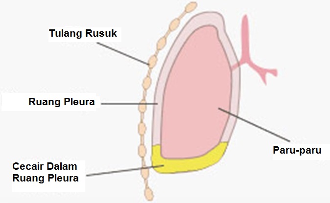 Biopsi Pleura (Konvensional) - PORTAL MyHEALTH