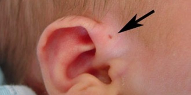 Lubang kecil di telinga menurut islam