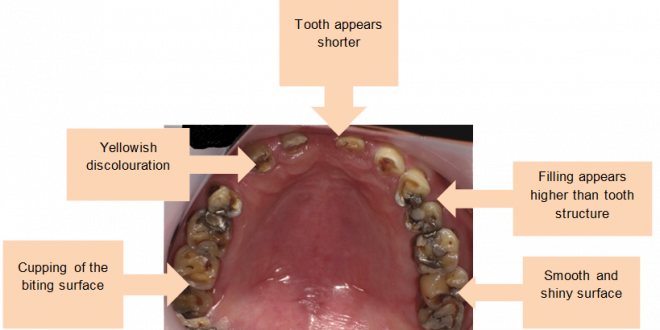 teeth decay acid reflux