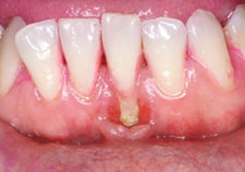 Periodontal Surgery With Soft Tissue Grafting